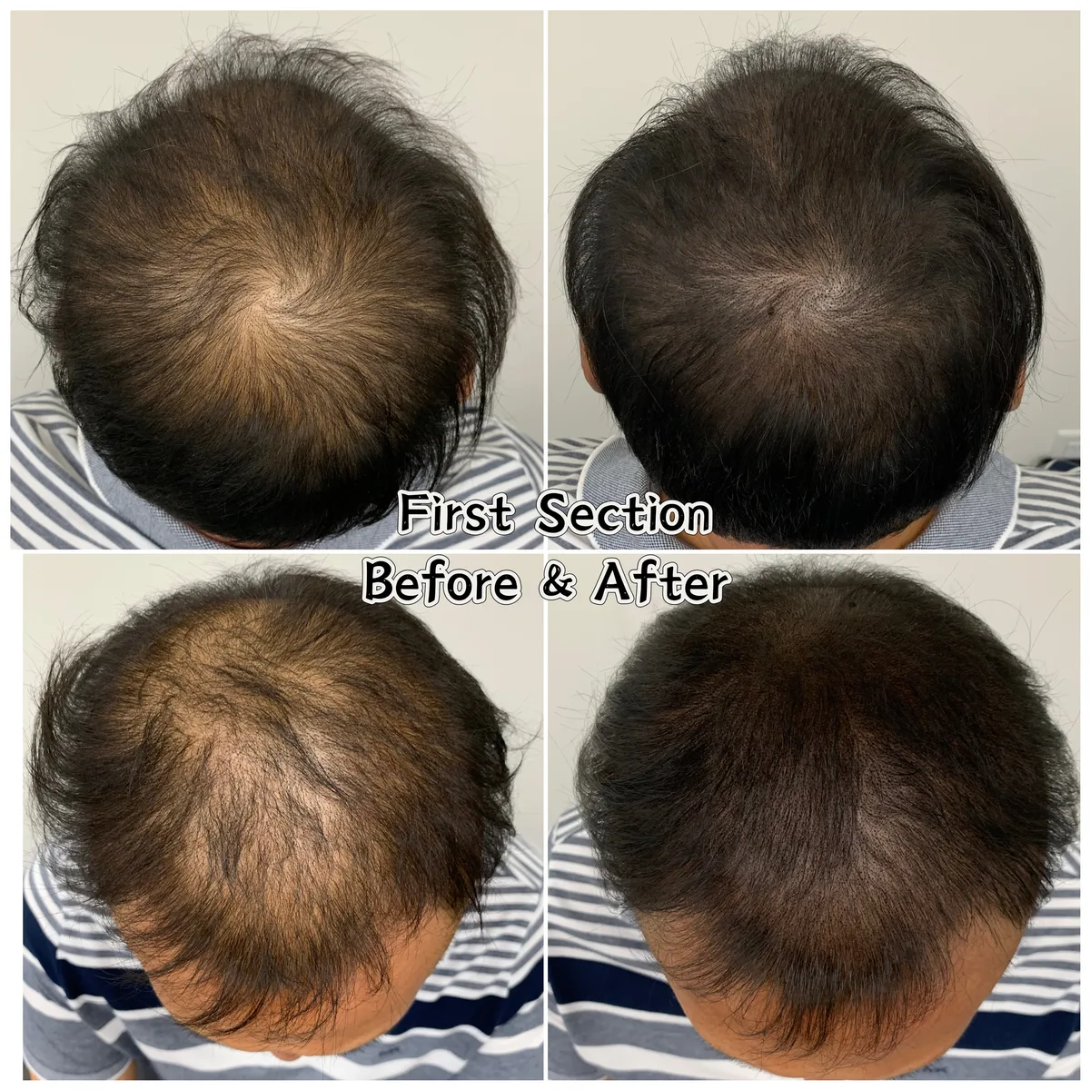 Scalp micropigmentation before and after — refined hairline and density