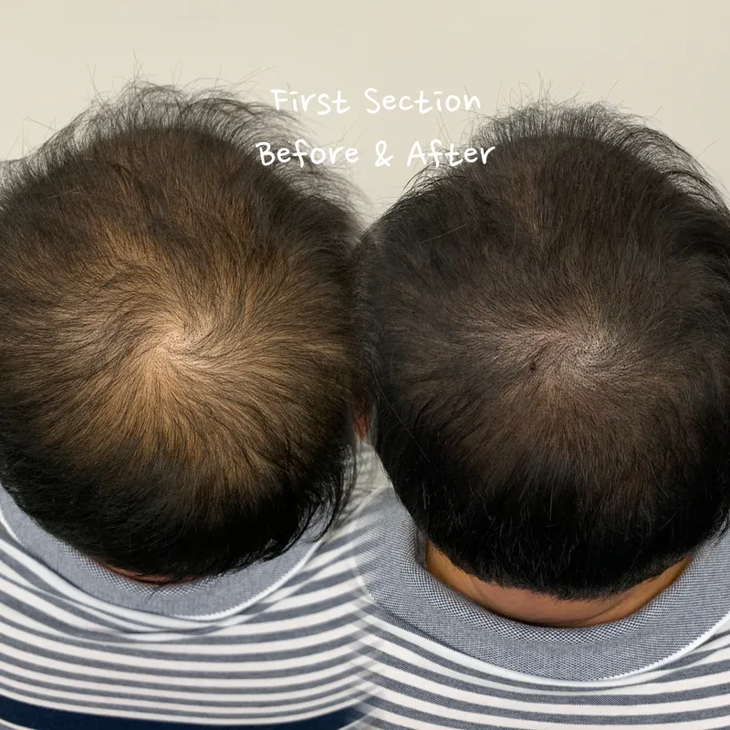 Scalp micropigmentation hairline result by Natural Brows